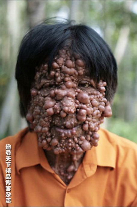 印尼男子全身长可怕肿瘤被称"泡泡人"